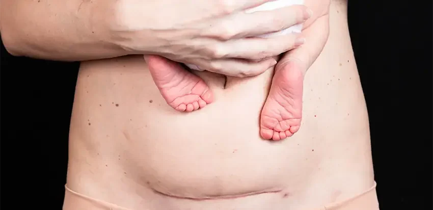 05 Complex Cesarean Section